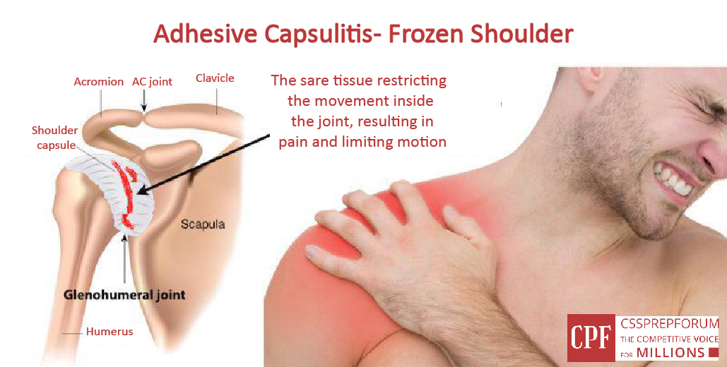 Effectiveness of Physical Therapy Rehabilitation in frozen shoulder or Adhesive capsulitis by Dr Sobia